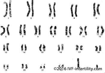 y chromosome microdeletion